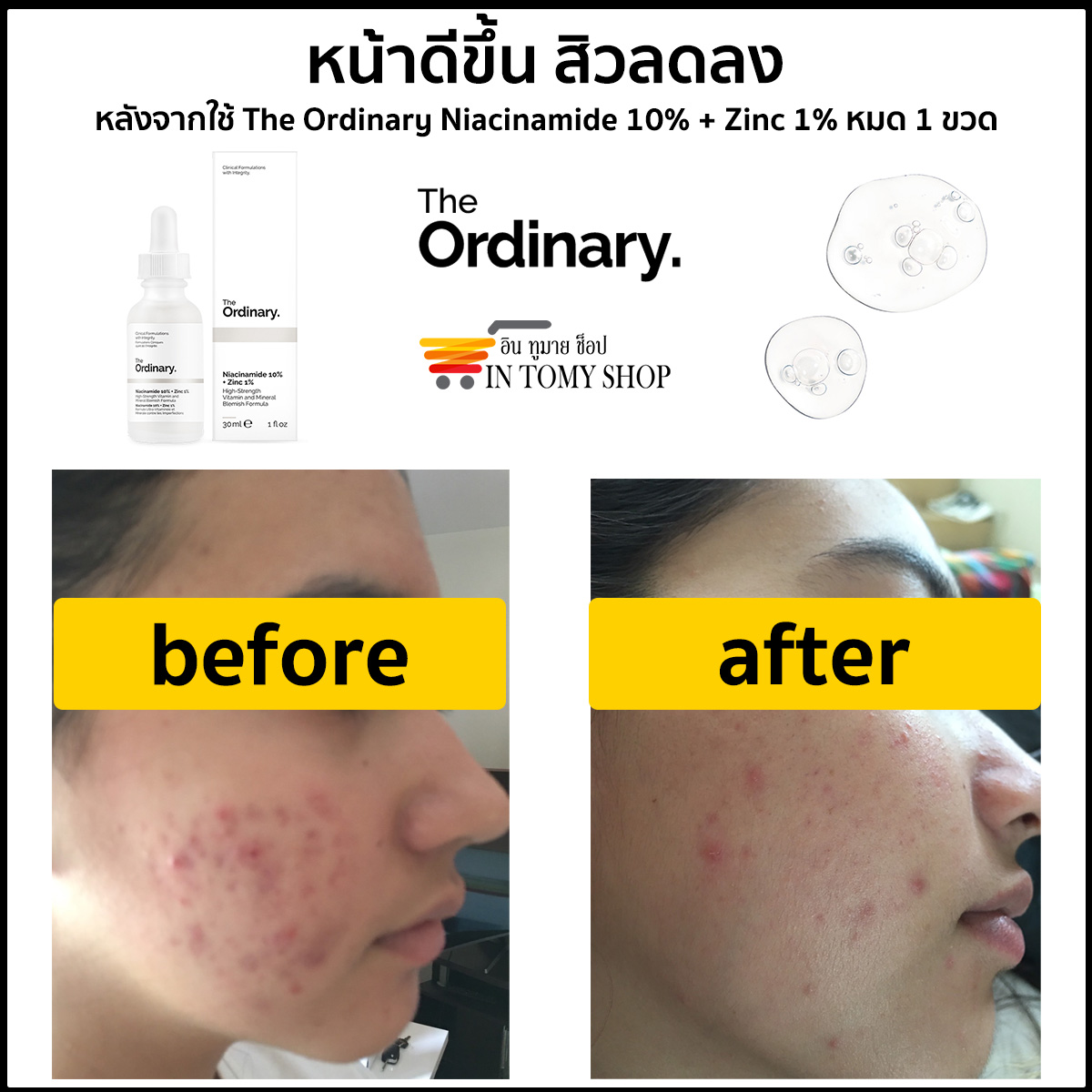 หน้าดีขึ้น สิวลดลง จาก The Ordinary Niacinamide 10% + Zinc 1%