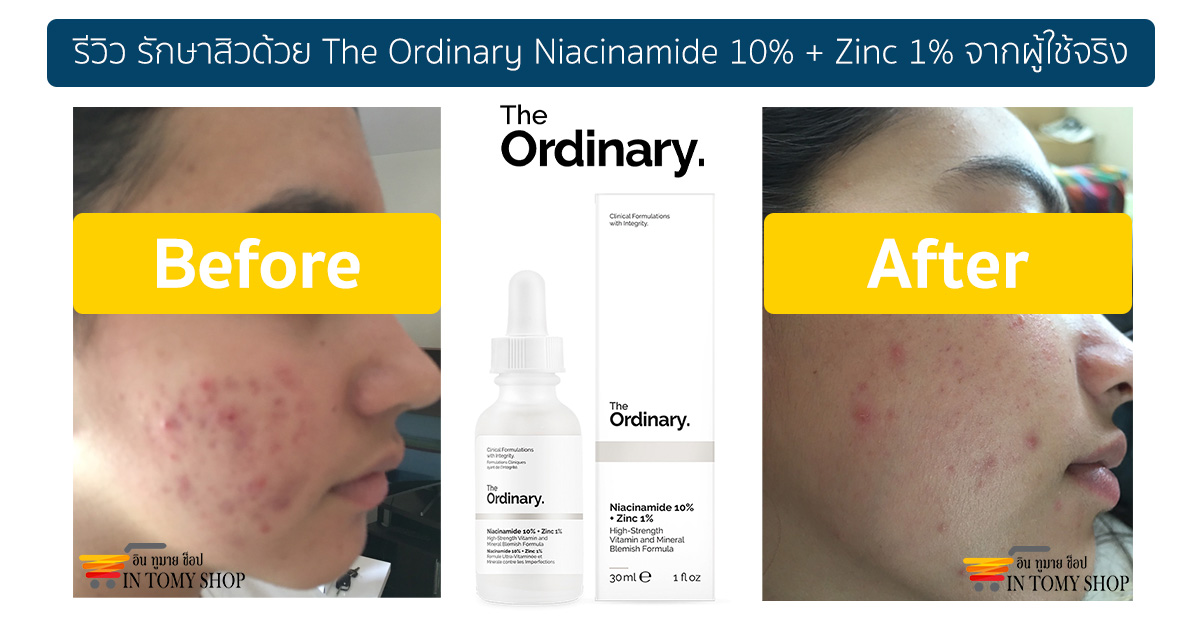 รีวิว-รักษาสิวด้วย-The-Ordinary-Niacinamide-10-Zinc-1-จากผู้ใช้จริง